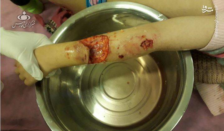 تصاویر دلخراش حمله دو سگ به دختر 10 ساله
