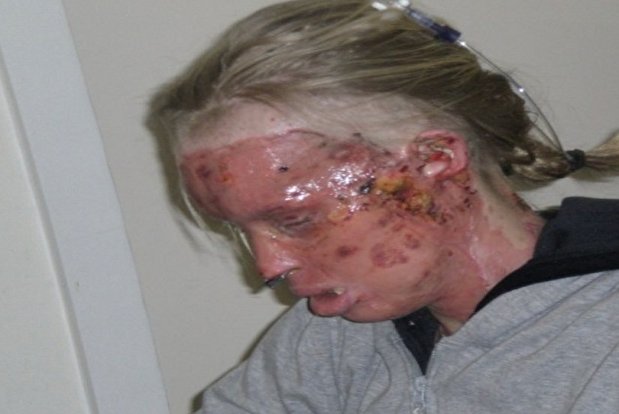 چهره سوخته مدل مشهور پس از حمله اسیدپاشی+ تصاویر