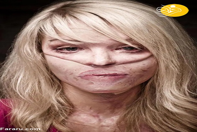 چهره سوخته مدل مشهور پس از حمله اسیدپاشی+ تصاویر