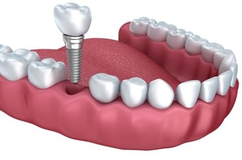 در مورد ایمپلنت دندان بیشتر بدانیم