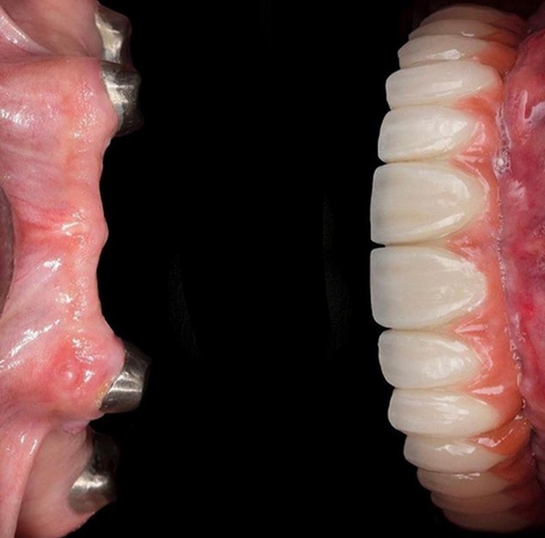 در مورد ایمپلنت دندان بیشتر بدانیم