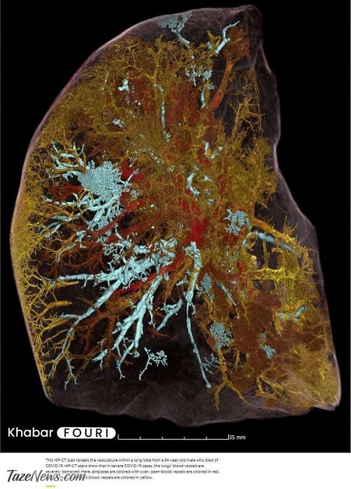 تصویر قوی‌ترین دستگاه ایکس‌ری جهان از ریه یک مرد فوت شده بر اثر کرونا