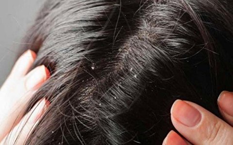 روش استفاده از اسپند برای درمان شپش سر