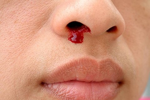 خونریزی بینی چه زمانی نگران کننده است؟ خونریزی بینی چه زمانی نگران کننده است؟