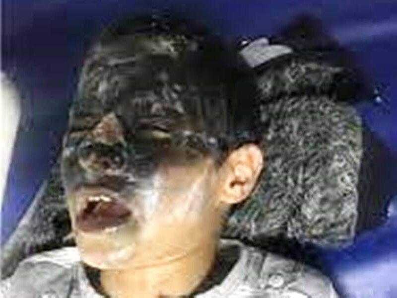 جوان ۲۲ ساله اراکی با انفجار مواد محترقه هر ۲ چشم خود را از دست داد