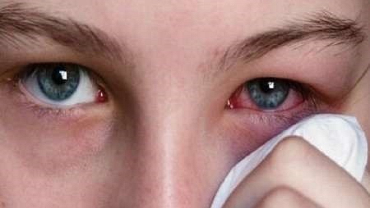  یک متخصص چشم درباره شست‌وشوی چشم با چای و تاثیرات آن، نکاتی را مطرح کرد. 