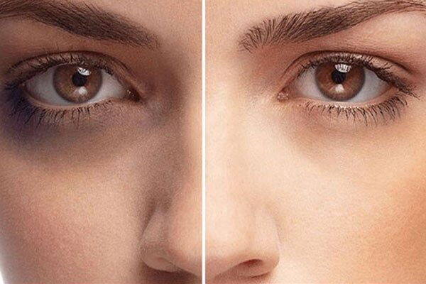 سیاهی دور چشم نشانه کمبود این ویتامین است | ویتامین‌های محافظ پوست کدام‌اند؟