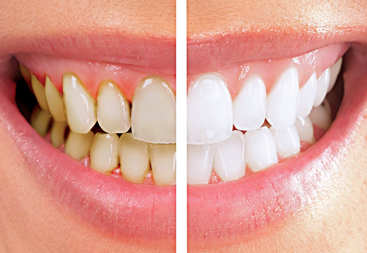 چند راهکار ساده برای سفید کردن دندان‌های زرد