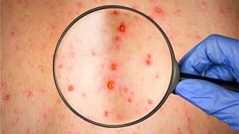 ابتلای مادر به سرخجه می‌تواند سبب سقط جنین شود