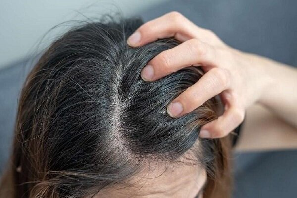 اگزمای پوست سر/ التهاب پنهانی که نباید نادیده گرفت