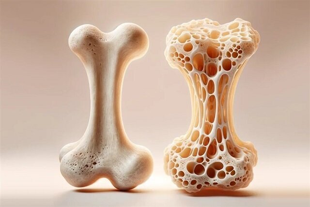 پوکی استخوان، بیماری خاموش، اما شایع