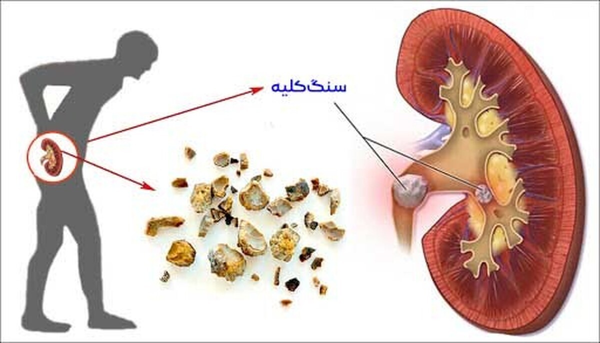 چه دارو‌هایی برای کلیه پر خطر هستند؟