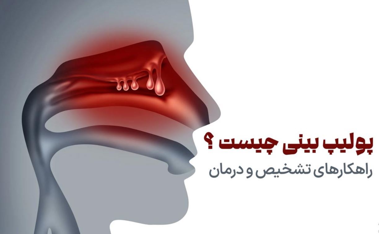 جراحی پولیپ بینی در کلینیک نورسا: درمان‌های پیشرفته و بهبودی سریع