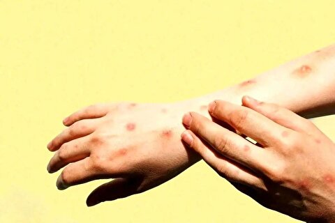 شناسایی ۱۱۰۷ بیمار مبتلا به تب دنگی در کشور/ صید پشه آئدس در ۱۱ استان