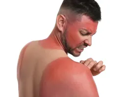 فقط یک آفتاب‌سوختگی شدید می‌تواند سلامت ما را برای همیشه تغییر دهد /سرطان پوست اینگونه به سراغمان می‌آید