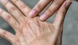 تأثیر خاموش آلودگی هوا بر سلامت و پیری پوست