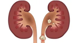 سنگ کلیه چه علائمی دارد؟