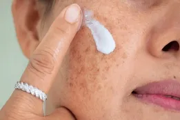 مراقب سوختگی‌های پنهان آفتاب باشید